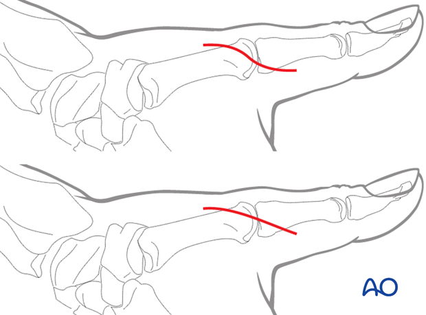 An incision starting dorsally, about 1 cm proximal to the MCP joint is extended in a palmar direction around the ulnar ...