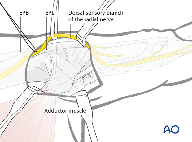 Identify and protect divisions of the dorsal sensory branch of the radial nerve, using a vessel loop.