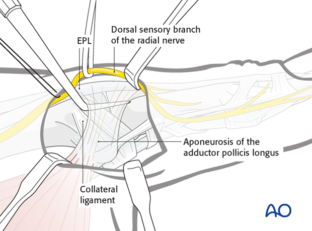 A dental pick is inserted deep to the aponeurosis of the adductor pollicis longus (APL) and between it and the ulnar ...