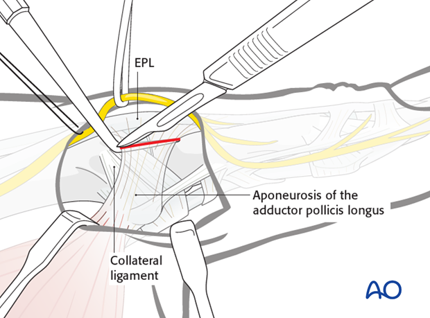 Make a longitudinal incision to divide the adductor aponeurosis close to its insertion into the EPL tendon.