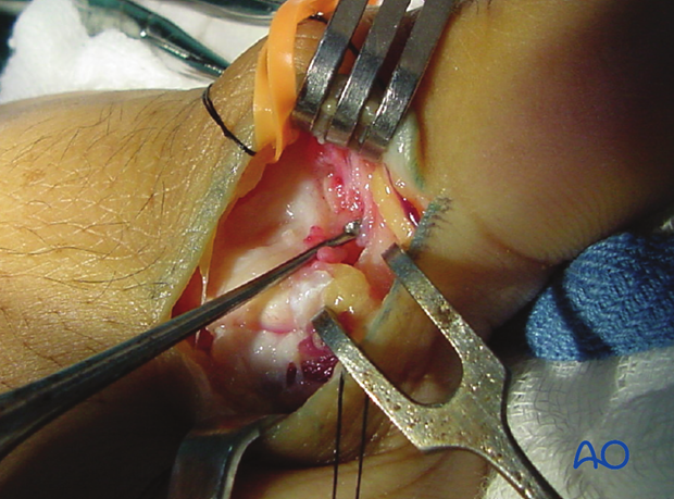 ... and pull EPL dorsally with a small retractor, exposing the ulnar collateral ligament and dorsal capsule.