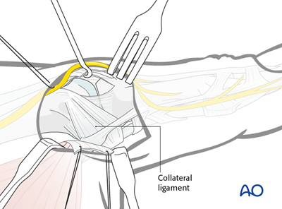 Dorsoulnar approach to the MCP joint of the thumb