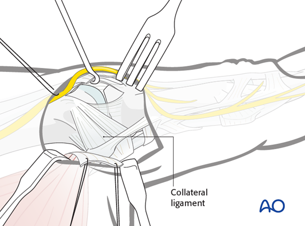 Make a longitudinal dorsal capsulotomy, avoiding disinsertion of the proximal attachment of the collateral ligament into the ...