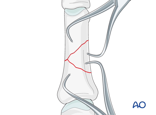 Wedge fractures of the proximal phalanx - Bridge plate fixation