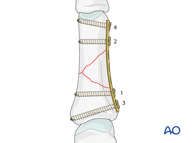 Wedge fractures of the proximal phalanx - Bridge plate fixation