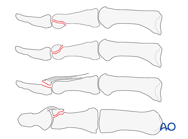 This approach is indicated for intraarticular fractures, arthrodesis and avulsion fractures.