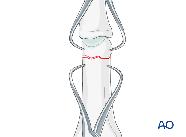 Reduction can be achieved by traction and flexion exerted by the surgeon, or by two pointed reduction forceps.