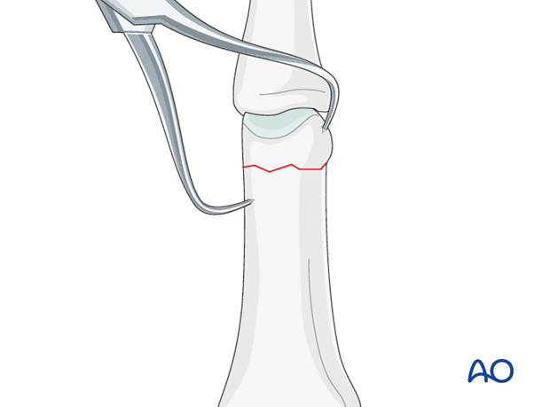 Direct reduction is necessary when the fracture can not be reduced by traction and flexion, or is unstable. 