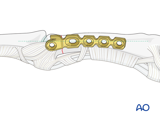 Transverse head fracture of the proximal phalanx – Minicondylar compression plate fixation