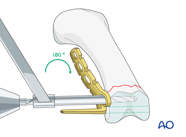 Transverse head fracture of the proximal phalanx – Minicondylar compression plate fixation