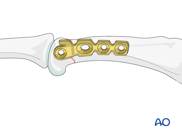 Short oblique head fracture of proximal phalanx – Minicondylar plate with lag screw