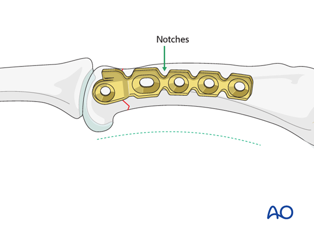 Transverse head fracture of the proximal phalanx – Minicondylar compression plate fixation