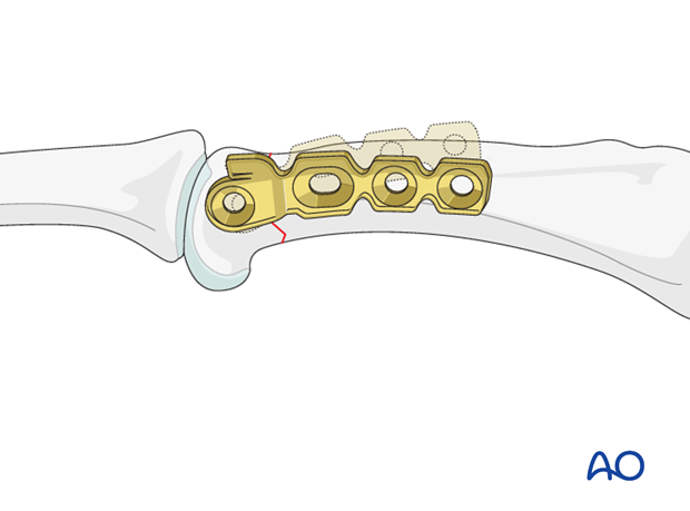 Short oblique head fracture of proximal phalanx – Minicondylar plate with lag screw