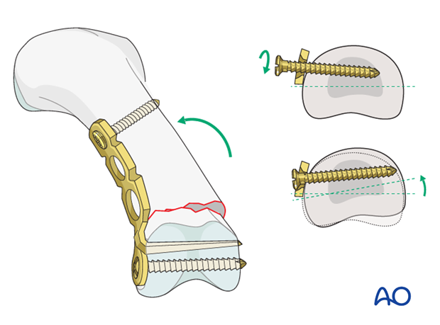 Transverse head fracture of the proximal phalanx – Minicondylar compression plate fixation