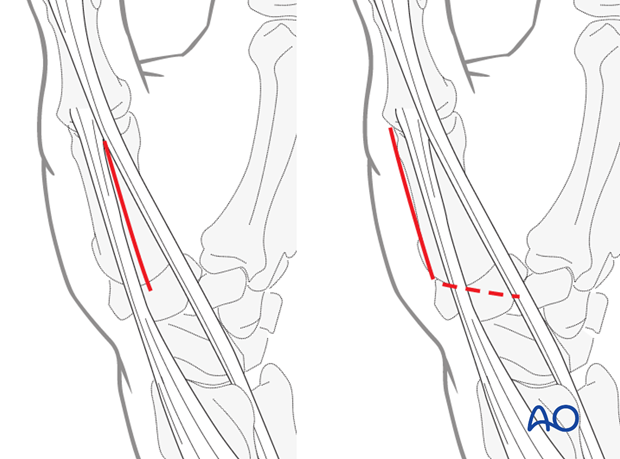 Make a straight skin incision over the interval between EPL and EPB throughout the length of the first metacarpal.