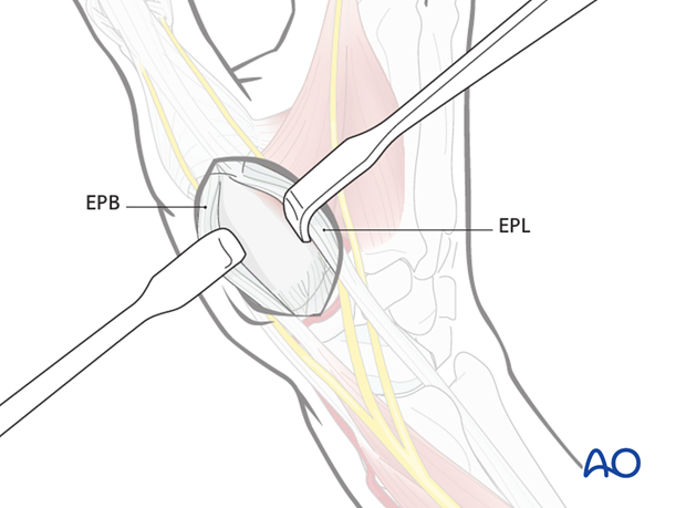 Incise the fascia between the EPL and EPB tendons and retract them to either side.