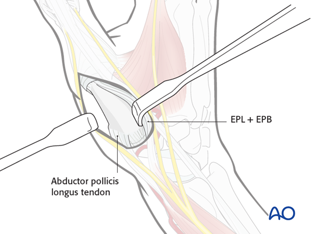 If the more radial skin incision has been chosen, incise the fascia on the radial side of EPB, and retract both tendons in ...