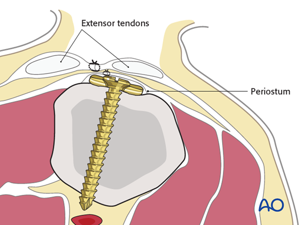 Lifting the periosteum and covering the implant with it, as far as possible, helps to minimize contact between extensor ...
