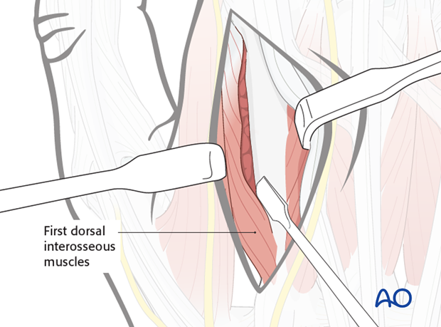 The extensor tendons can be retracted to the ulnar side, together with the surrounding loose connective tissue.