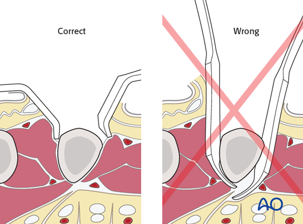 Avoid complete muscle detachment and injury to the volar structures. Use short, blunt retractors (Langenbeck) rather than ...
