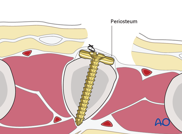 Cover the implant with the periosteum, as far as possible; this helps to minimize contact between the extensor tendons and ...