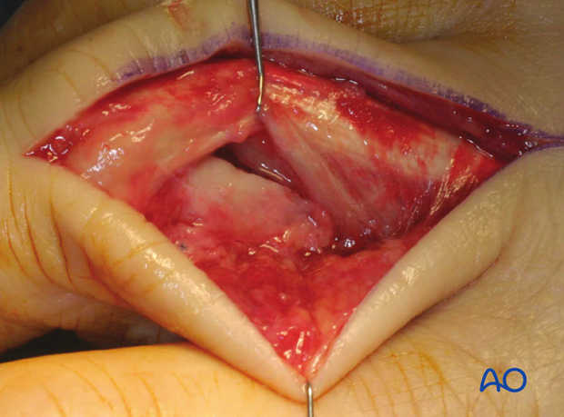 Long oblique head fracture of the proximal phalanx – Lag screw fixation 