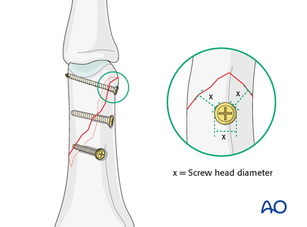 Long oblique head fracture of the proximal phalanx – Lag screw fixation