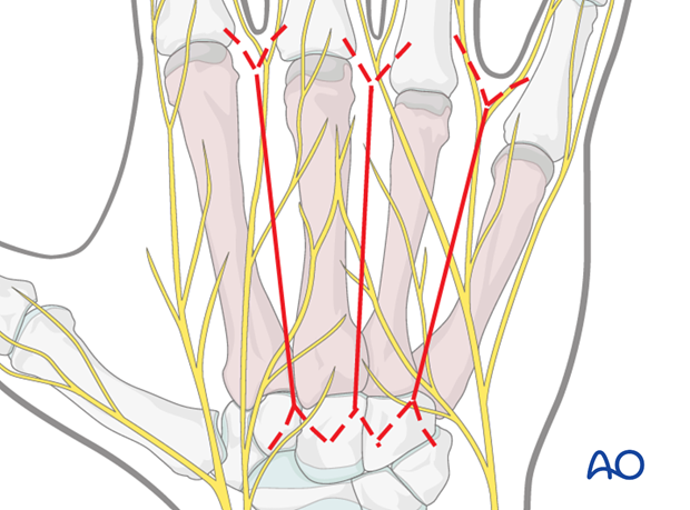 Make a straight longitudinal skin incision in the interval between adjacent metacarpal bones, not directly over the extensor ...