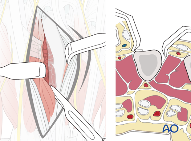 Partially detach the dorsal interosseous muscles from the bone subperiosteally.