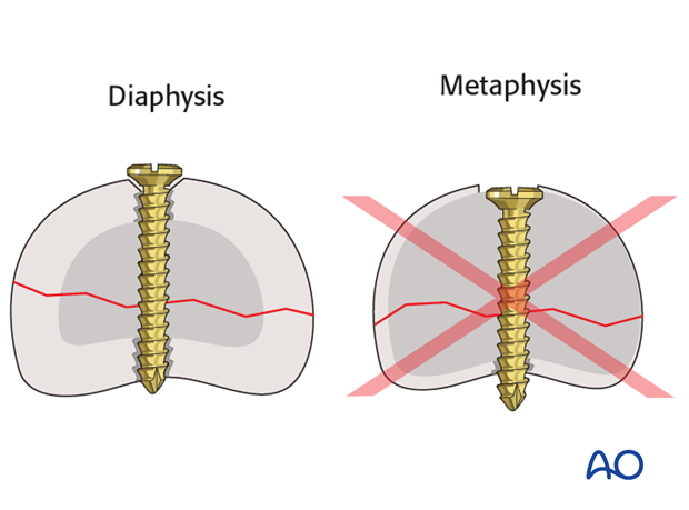 Do not countersink the screws in the metaphysis as its cortex is very thin. 