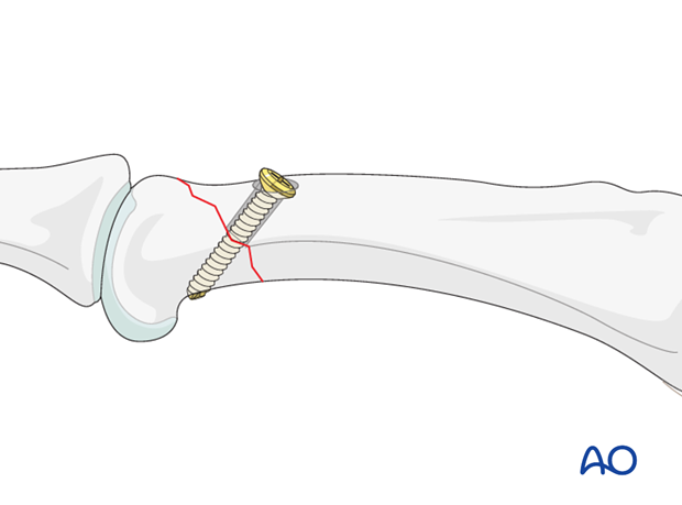 Short oblique head fracture of the proximal phalanx – Lag screw with protection plate