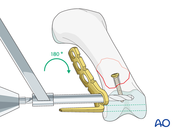 Short oblique head fracture of the proximal phalanx – Lag screw with protection plate