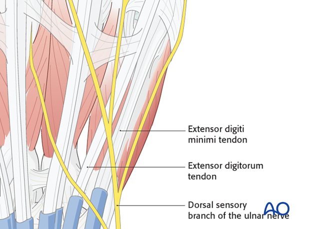 The extensor tendons of the little finger converge slightly towards the center of the wrist joint. The dorsal sensory ...