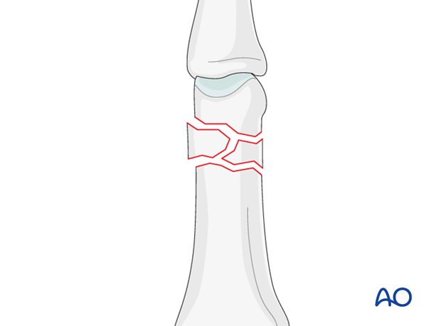 Comminuted fracture of the proximial phalanx meetaphysis – minicondylar bridge plate fixation