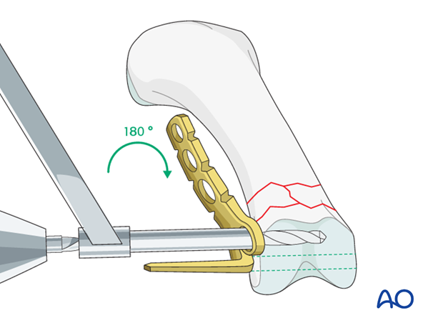 Comminuted fracture of the proximial phalanx meetaphysis – minicondylar bridge plate fixation
