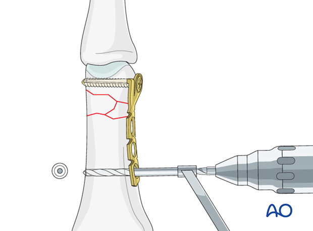 Comminuted fracture of the proximial phalanx meetaphysis – minicondylar bridge plate fixation