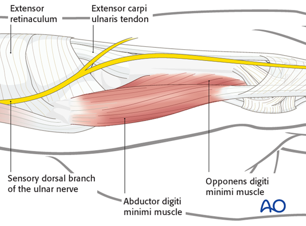 The insertion of the extensor carpi ulnaris tendon is onto the ulnar base of the fifth metacarpal. The sensory dorsal branch ...
