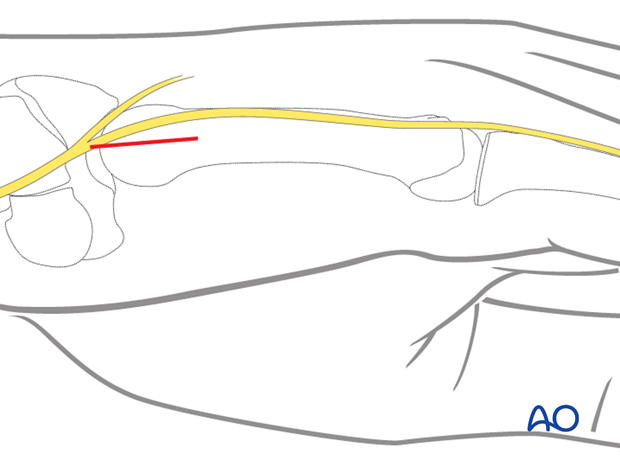 Make a short longitudinal incision over the dorso-ulnar base of the fifth metacarpal.