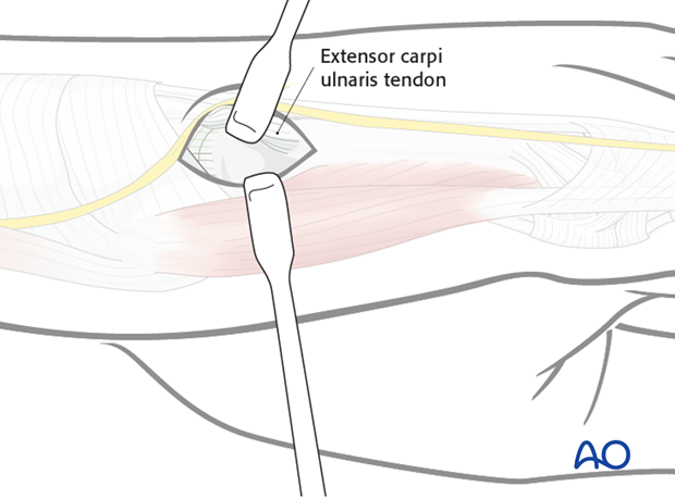 Be aware of the dorsal sensory branch of the ulnar nerve in the subcutaneous tissue, and use blunt dissection to expose the ...