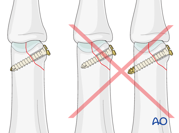 Oblique distal condylar fracture of the proximal phalanx – Lag screw fixation