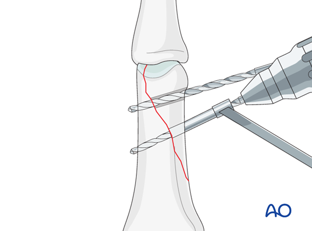 Oblique distal condylar fracture of the proximal phalanx – Lag screw fixation