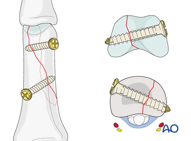 Oblique distal condylar fracture of the proximal phalanx – Lag screw fixation 