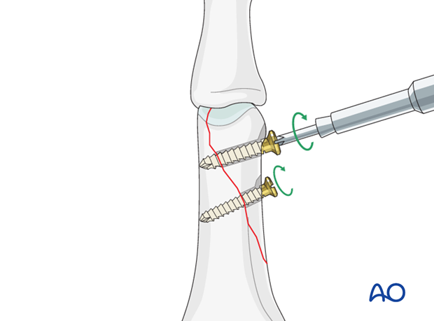 Oblique distal condylar fracture of the proximal phalanx – Lag screw fixation 