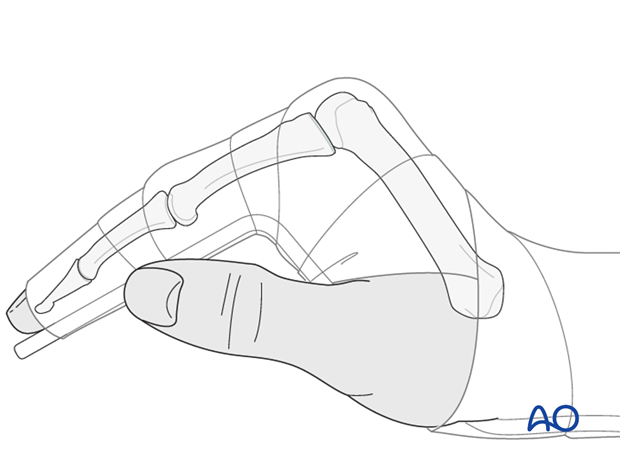 A removable splint may be applied at the end of the operation, with the hand in an intrinsic plus position (“safe” or “Edinburgh” position).