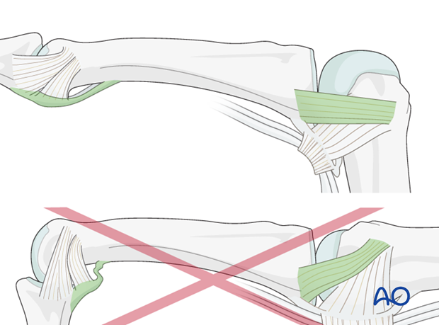 The reason of immobilization of the MCP joint in flexion is to maintain its collateral ligament at maximal length, avoiding scar contraction. PIP joint extension in this position also maintains length of the volar ...