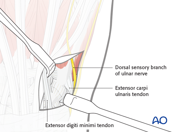 The extensor tendons are retracted radially together with the surrounding loose connective tissue. The dorsal sensory branch ..