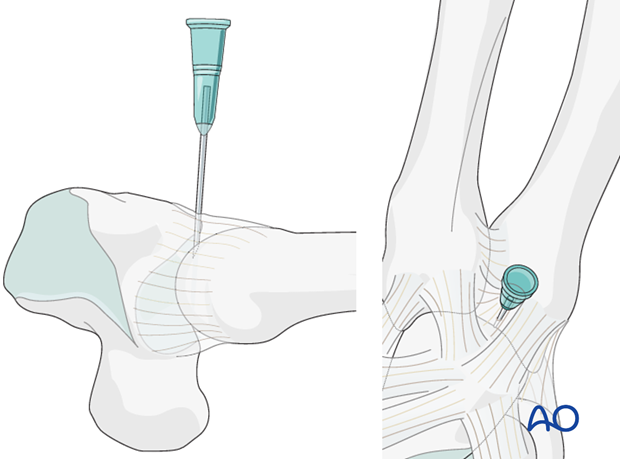 If a capsulotomy is not needed, mark the position of the joint with a hypodermic needle or a small K-wire in order to ...