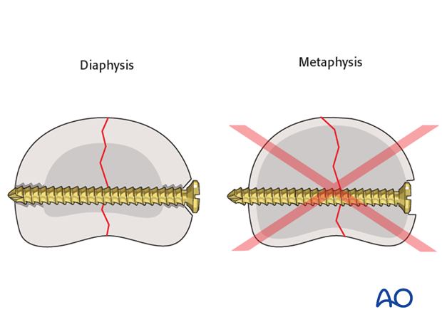 Do not countersink the screws in the metaphysis as its cortex is very thin. If countersinking is attempted, all purchase ...
