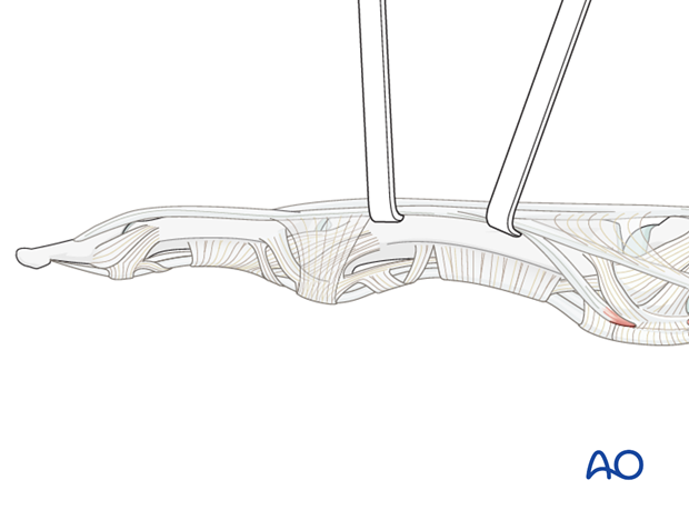 Midaxial approach to the proximal phalanx