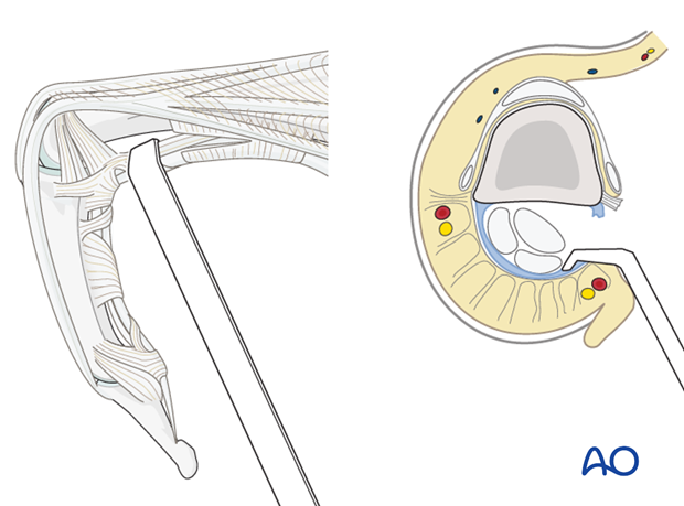 Midaxial approach to the proximal phalanx